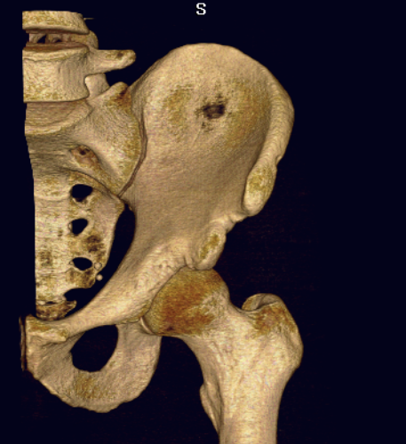 Subspine Impingement 1